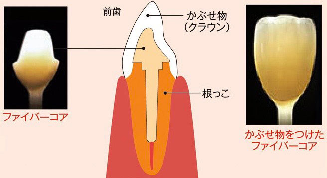 コア(グラスファイバーコア)
