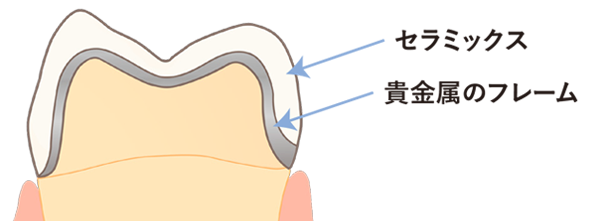 セラミッククラウン